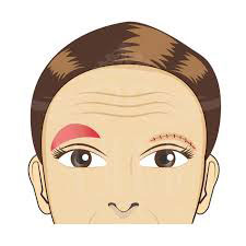 Closing scars with eyebrow tattooing Closing scars with eyebrow tattooing