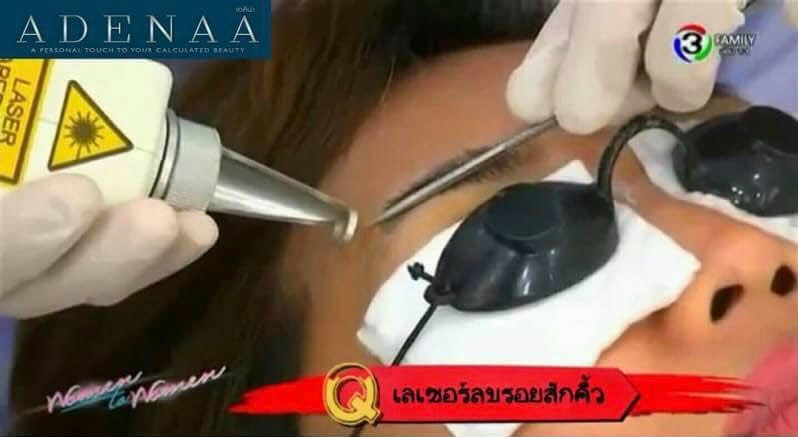 Remove eyebrow tattoos with laser