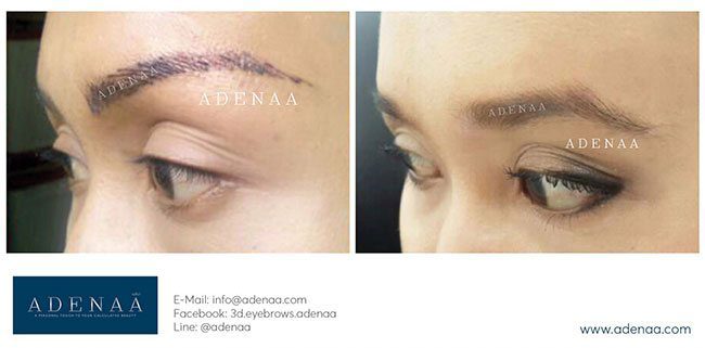 Remove eyebrow tattoos with laser
