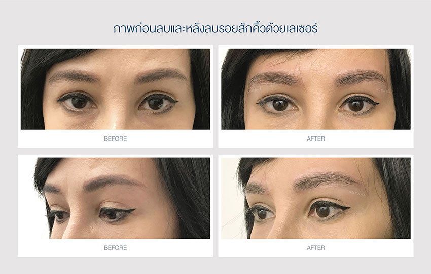 eyebrow tattoo removal