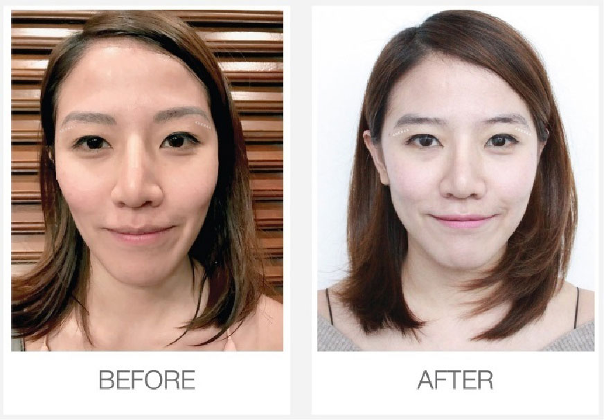 Remove eyebrow tattoos with laser
