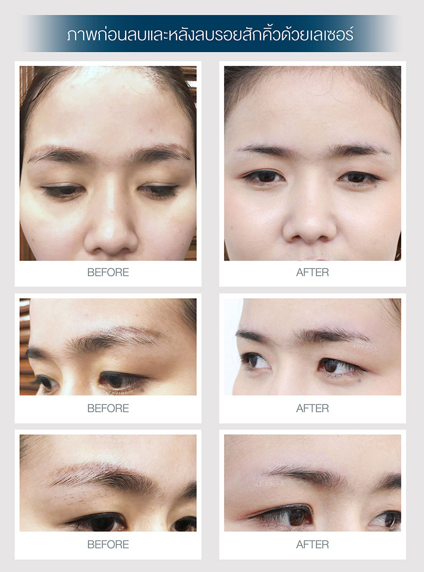 eyebrow tattoo removal
