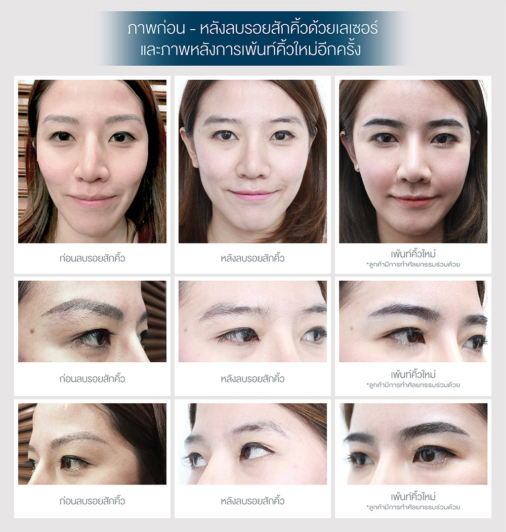 eyebrow tattoo removal