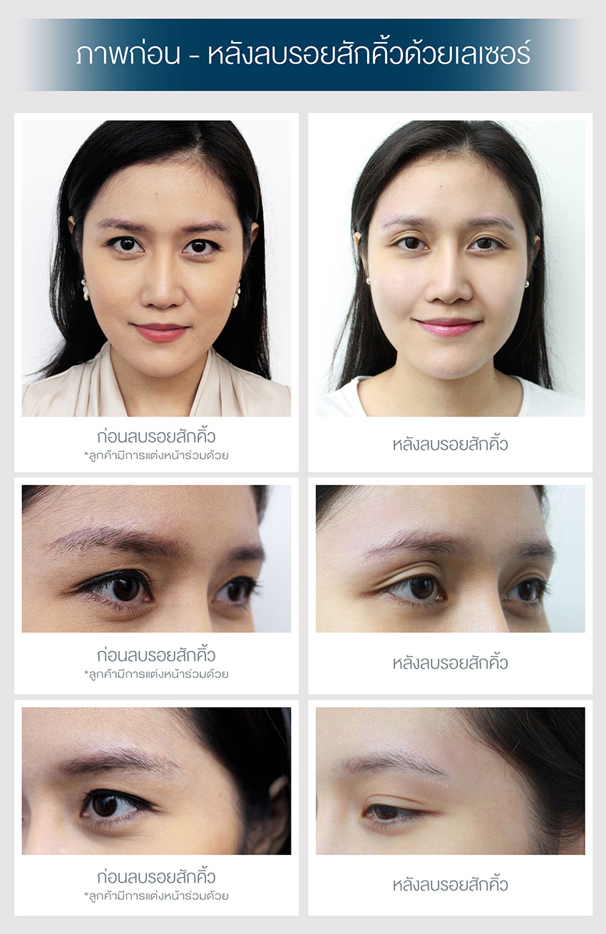 eyebrow tattoo removal