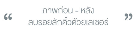 เลเซอร์ลบรอยสักคิ้ว เลเซอร์ลบรอยสักคิ้ว
