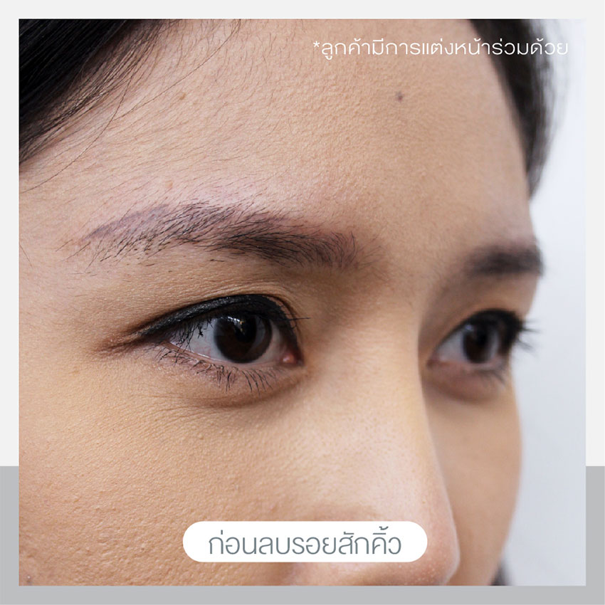 เลเซอร์ลบรอยสักคิ้ว เลเซอร์ลบรอยสักคิ้ว