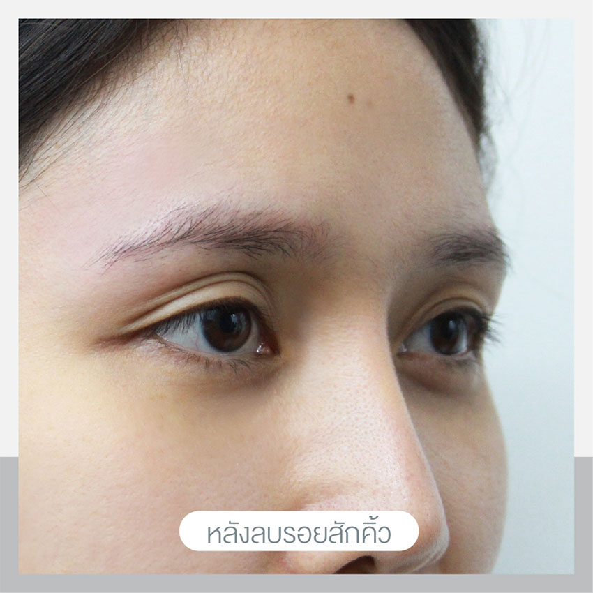 เลเซอร์ลบรอยสักคิ้ว เลเซอร์ลบรอยสักคิ้ว
