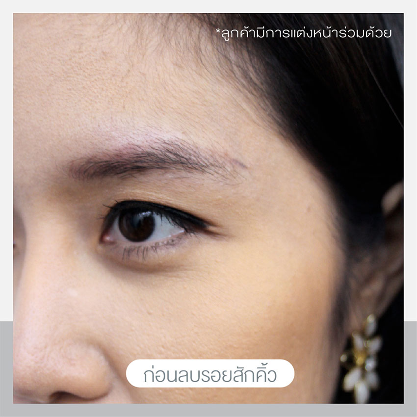 เลเซอร์ลบรอยสักคิ้ว เลเซอร์ลบรอยสักคิ้ว