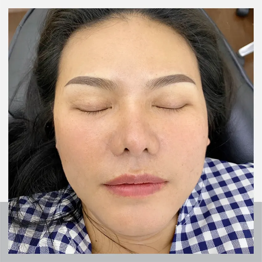 In the case of eyebrow loss due to severe allergic reaction to cosmetics, it can be fixed with Ombre.