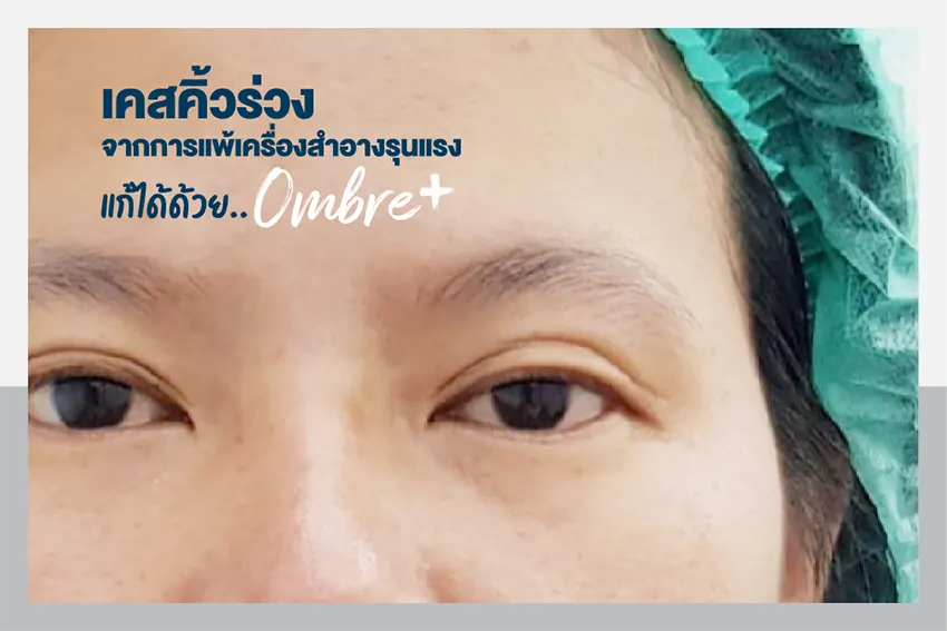 In the case of eyebrow loss due to severe allergic reaction to cosmetics, it can be fixed with Ombre. In the case of eyebrow loss due to severe allergic reaction to cosmetics, it can be fixed with Ombre.