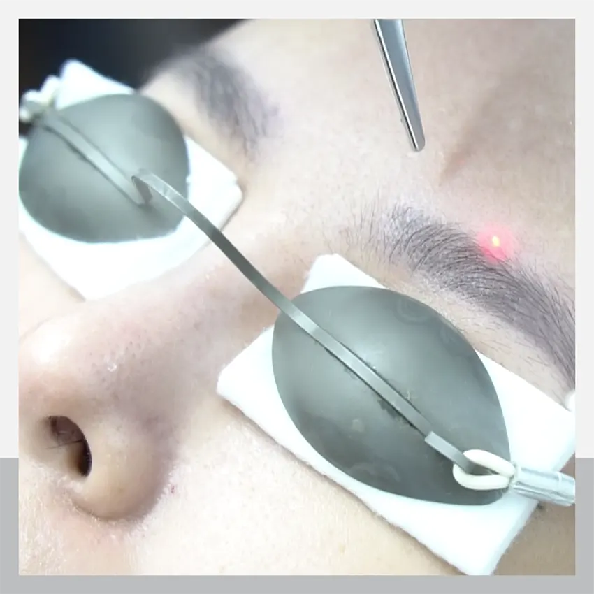 ลบรอยเพ้นท์คิ้วแบบผิวไม่พัง ต้องที่ Adenaa