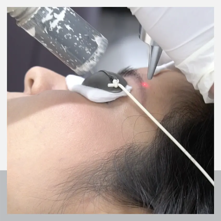 ลบรอยเพ้นท์คิ้วแบบผิวไม่พัง ต้องที่ Adenaa