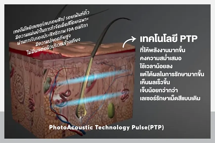 ลบรอยเพ้นท์คิ้วแบบผิวไม่พัง ต้องที่ Adenaa