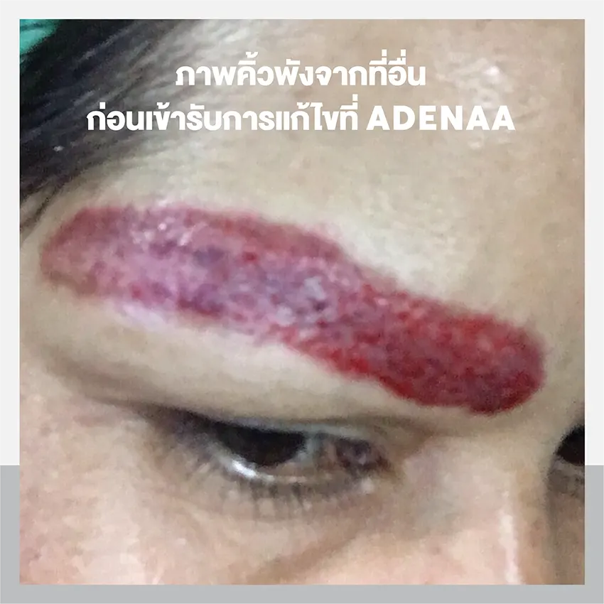 คิ้วพังรีวิวลบคิ้วผิดวิธี