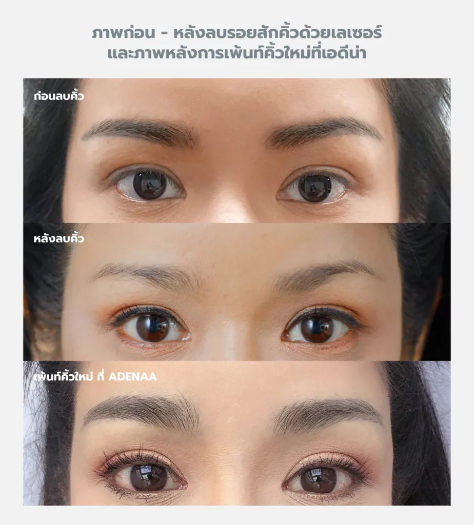 ภาพตัวอย่าง การลบรอยสักคิ้ว ด้วย เลเซอร์